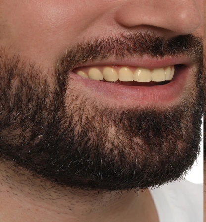 collage-with-photos-man-before-after-tooth-whitening-closeup 1 (4)