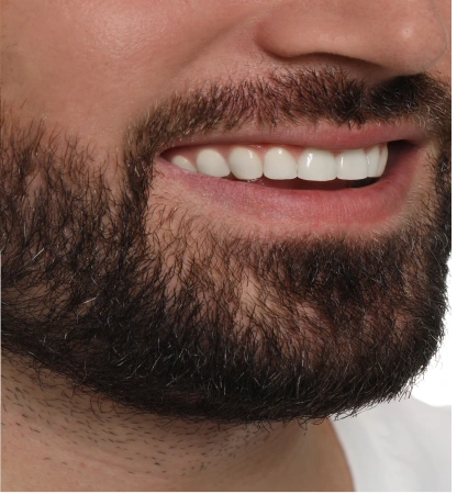 collage-with-photos-man-before-after-tooth-whitening-closeup 1 (5)