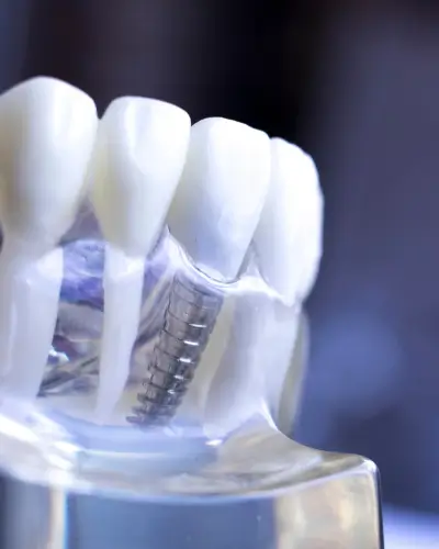 procedure dental implants