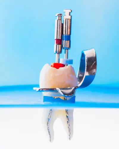 procedure endodontics