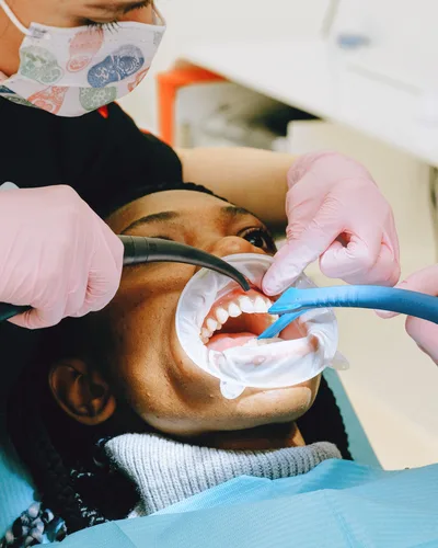 Gum Contouring procedure at The Dental Club