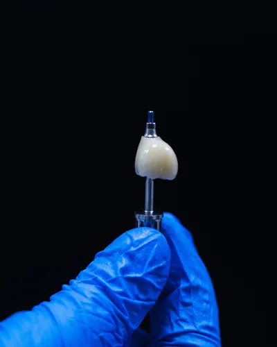 Single Tooth Implant procedure at The Dental Club