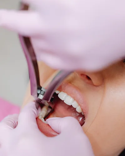 Teeth Pulling & Extraction procedure at The Dental Club