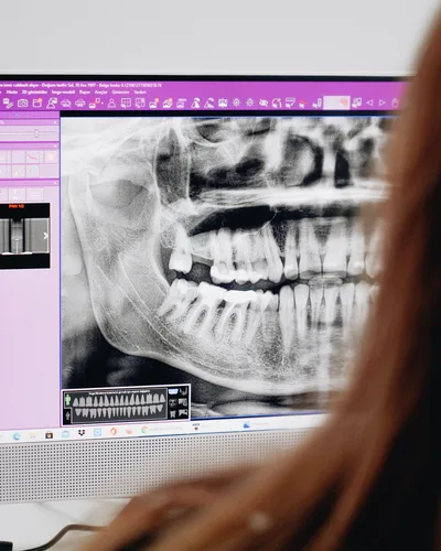 TMJ Treatment procedure at The Dental Club