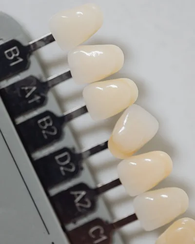 Veneers procedure at The Dental Club